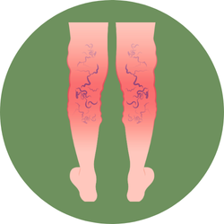 Varicose Veins