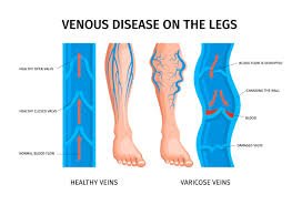 Varicose Veins
