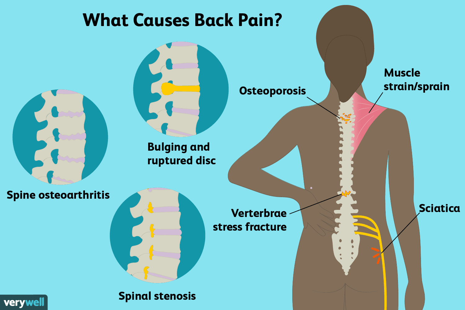 Low Back Pain